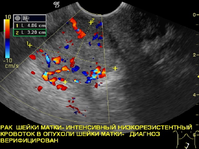 Новообразование эндометрия. Ультразвуковое исследование шейки матки при раке.. Рпкмшейки матки на УЗИ. Опухоль шейки матки на УЗИ.