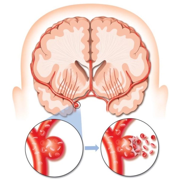 Аневризмы сосудов головного мозга: причины, симптомы и лечение