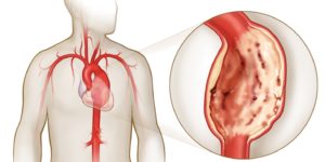 Атеросклероз аорты сердца: причины, симптомы, лечение народными средствами и медикаментами