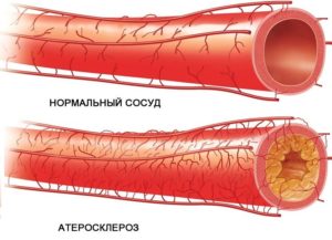 Атеросклероз аорты сердца: причины, симптомы, лечение народными средствами и медикаментами