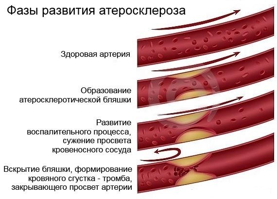 Атеросклероз сосудов нижних конечностей: симптомы, диагностика и лечение