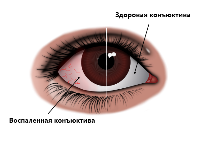 Что делать, если лопнул сосуд в глазу: виды кровоизлияний и лечение