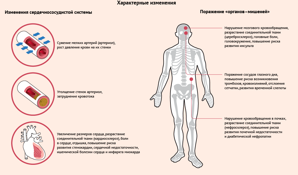 Гипертоническая болезнь: стадии, симптоматика, причины и лечение