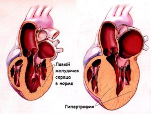 Гипертрофия левого желудочка сердца: причины, способы лечения народными средствами и медикаментами