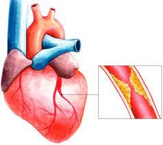 Все об инфаркте миокарда: причины, симптомы, диагностика и первая помощь