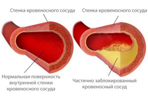 Атеросклероз сердца: лечение, причины и симптомы заболевания