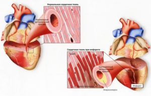 Атеросклероз сердца: лечение, причины и симптомы заболевания