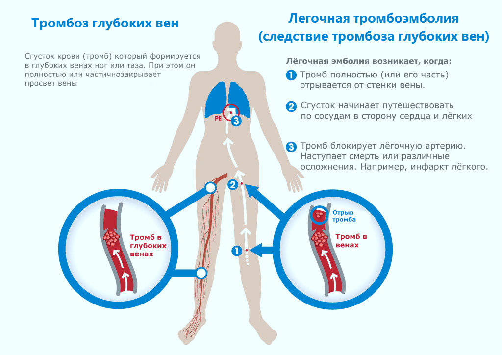Причины тромбоза глубоких вен нижних конечностей, терапия и профилактика