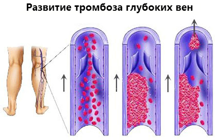 Причины тромбоза глубоких вен нижних конечностей, терапия и профилактика