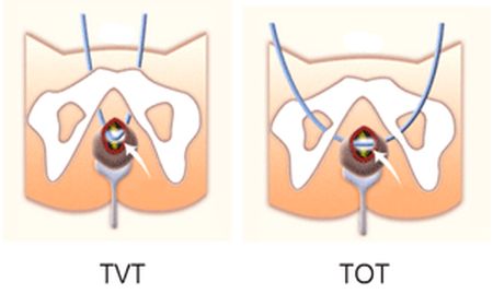 Недержание мочи операция. Операция TVT-O при недержании. Слинговые операции при недержании мочи. Слинговые операции TVT И TVT-O. TVT операции при недержании.