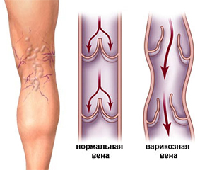 Варикозная болезнь вен нижних конечностей: стадии, причины, симптомы и лечение